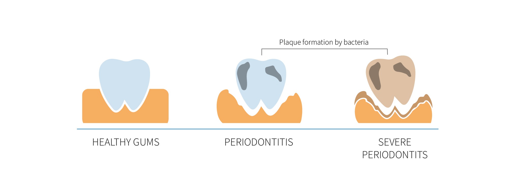 Periodontitis symptoms