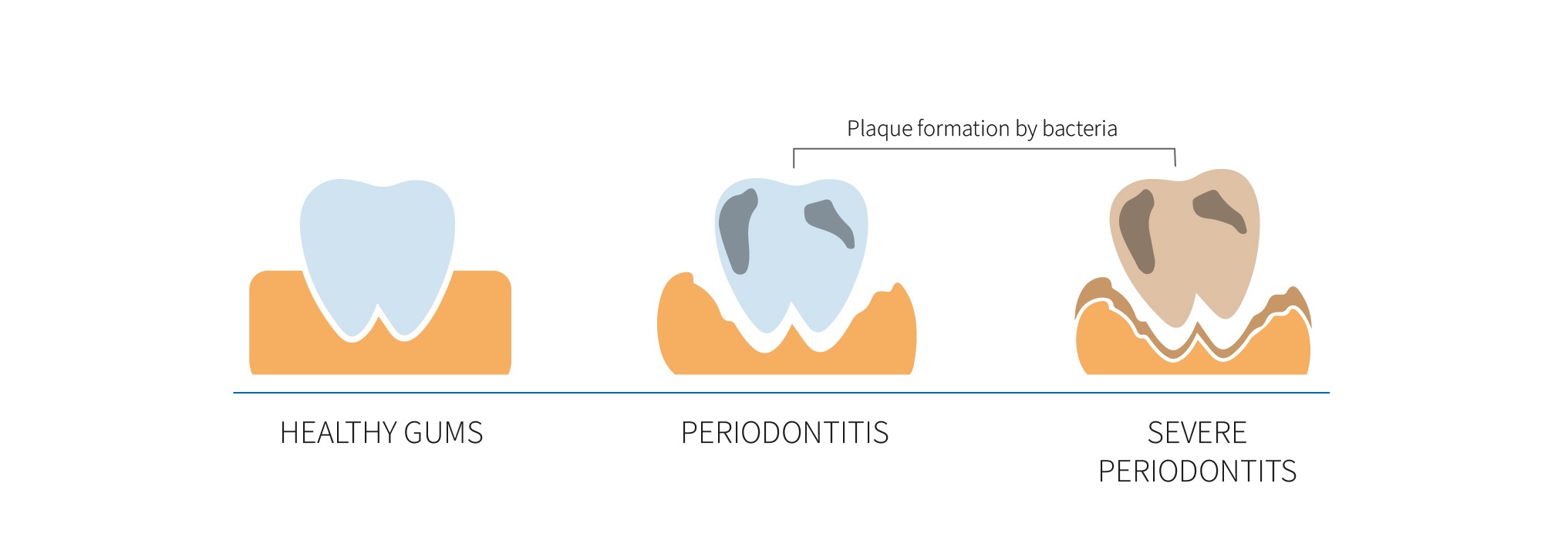 periodontitis-symptoms Periodontitis symptoms