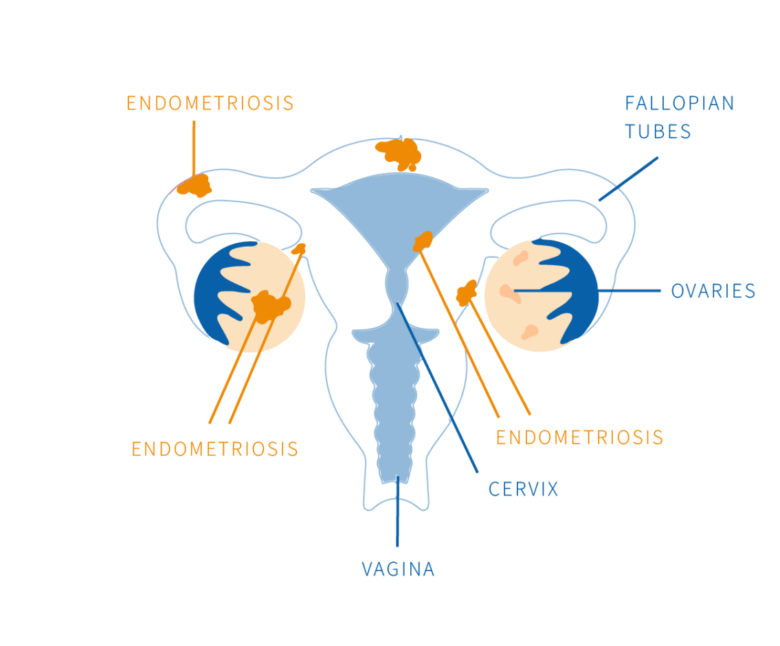 Endometriosis and Immunity Microimmunotherapy