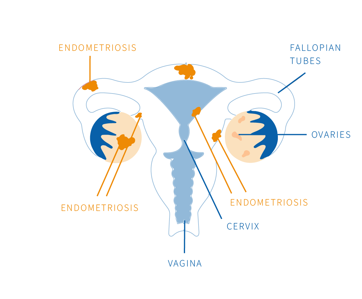 endometriosis